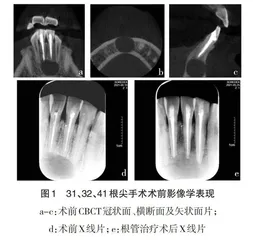 3D打印颌骨模型用于根尖手术教学的探索与实践