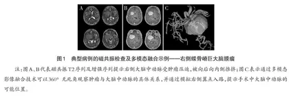 多模态影像融合及CBL在神经外科教学中的应用