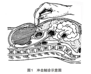 腹部冲击触诊法简便模具制作及教学应用