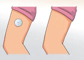 用“小硬币”打点滴1