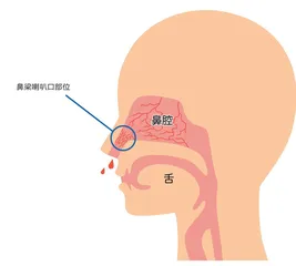 鼻出血一定是秋燥冬上火?别不当回事儿1