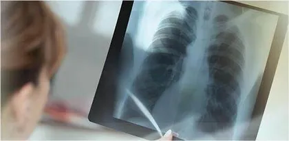 肺部磨玻璃结节科学应对有良方