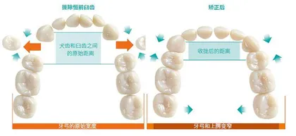 正畸后遗症:牙齿矫正的隐忧2