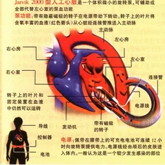 重塑人工心脏2
