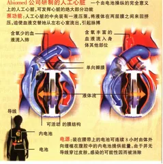 重塑人工心脏3