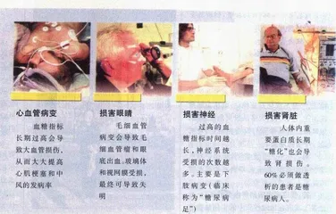 欧洲怎样治糖尿病