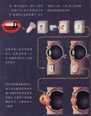 用自身的牙修补眼睛