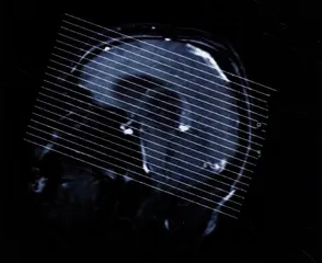 法律宣判的脑死亡1