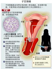 子宫颈癌有多远4