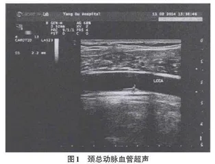 基于数据挖掘技术对颈动脉硬化斑块的诊断研究